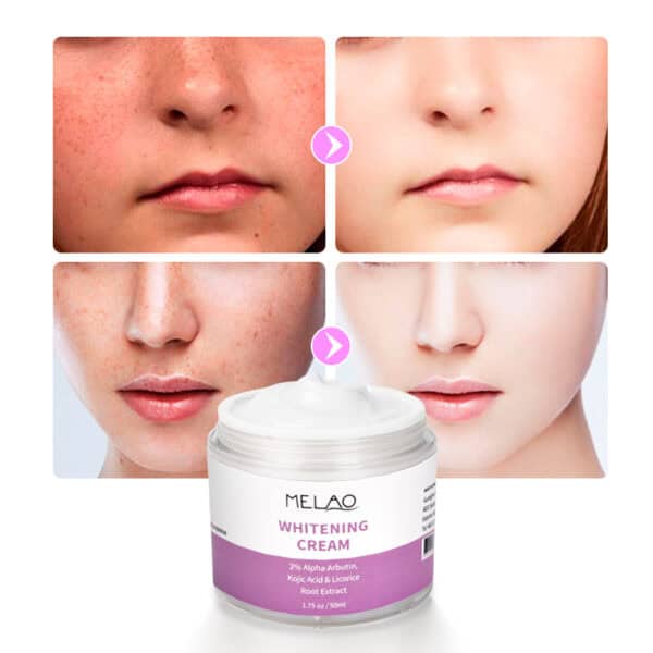 whitening cream 50 ml - pigmentvlekken crème 50 ml - voor en na gebruik